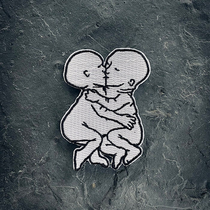 Conjoined twins, siamese foetus - PATCH